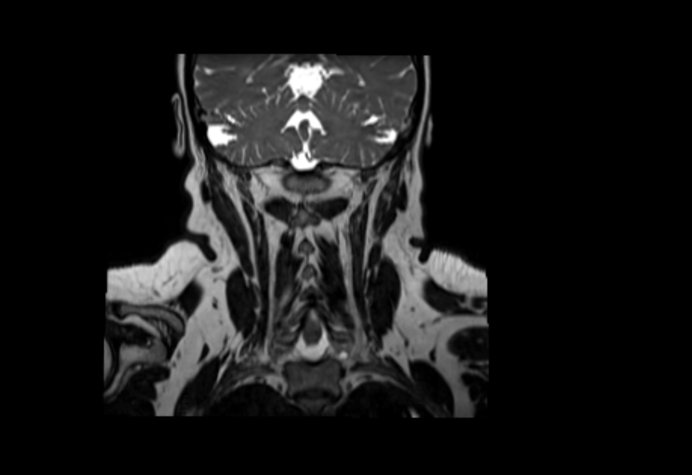 Neck coronal lymph node cross sectional MRI anatomy 3T MRI  image-img-00001-00018.webp